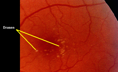 Close-up of the Macula with Drusen