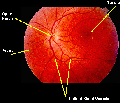 Photograph of the Retina showing Macula with Drusen